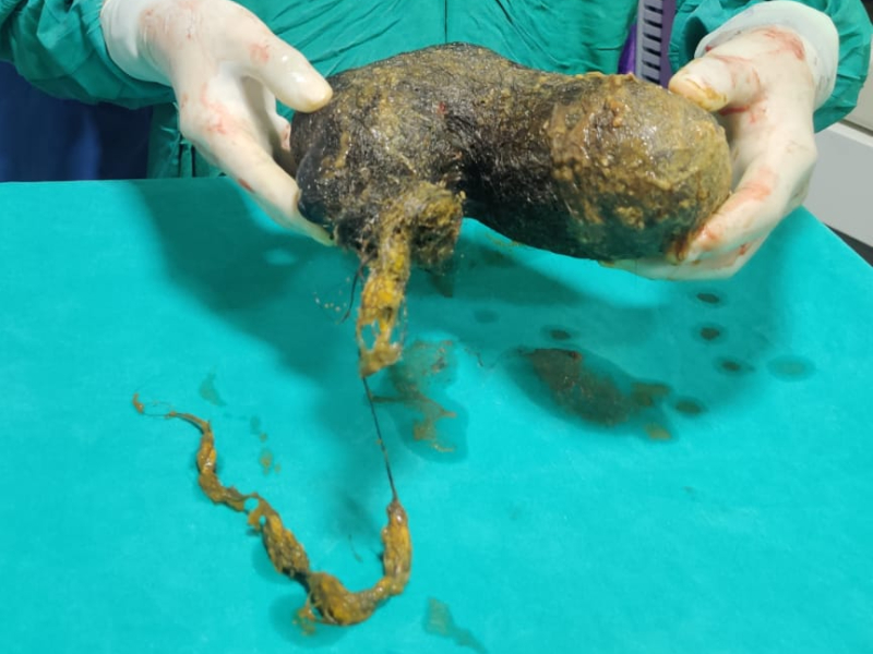 Bizarre! Ball of hair recovered from teenager’s stomach in western India