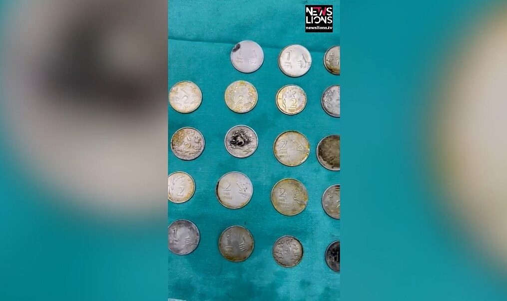 Doctors remove coins, magnets from 26-year-old’s stomach in northern India