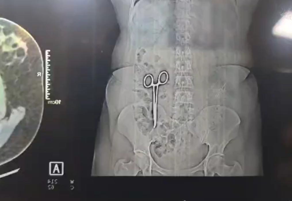 Doctors left baffled after CT scan reveals pair of scissors in woman’s lower abdomen